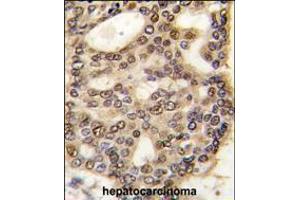 Formalin-fixed and paraffin-embedded human hepatocarcinoma tissue reacted with HDGF antibody , which was peroxidase-conjugated to the secondary antibody, followed by DAB staining.