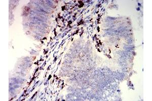 Immunohistochemical analysis of paraffin-embedded rectum cancer tissues using CD274 mouse mAb with DAB staining. (PD-L1 anticorps  (AA 24-153))