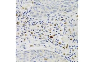 Immunohistochemistry of paraffin-embedded human lung cancer using GEMIN2 Antibody. (SIP1 anticorps)