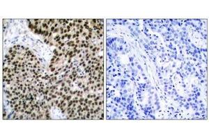 Immunohistochemical analysis of paraffin-embedded human breast carcinoma tissue using HSF1 (Ab-303) antibody (E021255). (HSF1 anticorps)