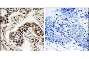 Immunohistochemistry analysis of paraffin-embedded human breast carcinoma, using NudC (Phospho-Ser326) Antibody. (NUDC anticorps  (pSer326))