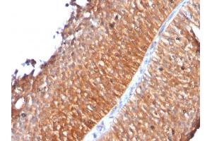 Formalin-fixed, paraffin-embedded human Bladder Carcinoma stained with Mitochondria Monoclonal Antibody (MTC719) (Mitochondrial Marker anticorps)