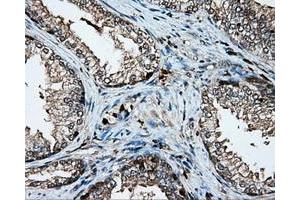 Immunohistochemical staining of paraffin-embedded Adenocarcinoma of colon tissue using anti-PLEK mouse monoclonal antibody. (Pleckstrin anticorps)