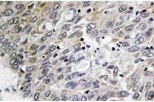 Immunohistochemistry (IHC) analyzes of C1q-C antibody in paraffin-embedded human lung carcinoma tissue. (C1QC anticorps)