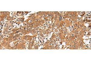Immunohistochemistry of paraffin-embedded Human cervical cancer tissue using GFI1 Polyclonal Antibody at dilution of 1:100(x200)