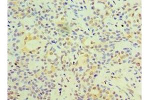 Immunohistochemistry of paraffin-embedded human breast cancer using ABIN7153128 at dilution of 1:100