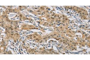 Immunohistochemistry of paraffin-embedded Human gastric cancer using NAPSA Polyclonal Antibody at dilution of 1:50 (NAPSA anticorps)