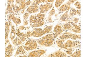 FUT6 Antibody at 1/100 staining Human liver cancer by IHC-P. (FUT6 anticorps  (N-Term))