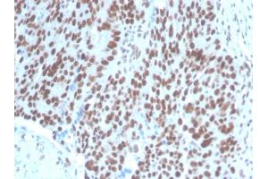 Formalin-fixed, paraffin-embedded human Ovarian Carcinoma stained with PAX2 Mouse Monoclonal Antibody (PAX2/1104).