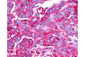 Anti-TAAR6 antibody IHC of human Ovary, Carcinoma. (TAAR6 anticorps  (C-Term))