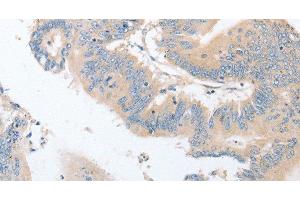 Immunohistochemistry of paraffin-embedded Human colon cancer using EPS15L1 Polyclonal Antibody at dilution of 1:30 (EPS15L1 anticorps)