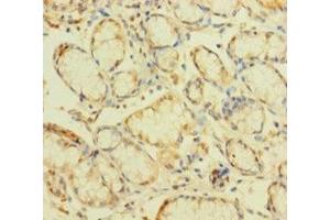 Immunohistochemistry of paraffin-embedded human gastric cancer using ABIN7176189 at dilution of 1:100 (ZNF26 anticorps  (AA 335-533))