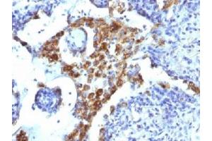 Formalin-fixed, paraffin-embedded human lung adenocarcinoma stained with Napsin-A antibody (NAPSA/1239). (NAPSA anticorps)