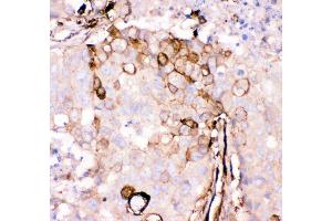 Anti- Gelsolin antibody, IHC(P) IHC(P): Human Mammary Cancer Tissue (Gelsolin anticorps  (AA 580-782))