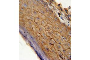 CB2 antibody (C-term) (ABIN654631 and ABIN2844327) immunohistochemistry analysis in formalin fixed and paraffin embedded human skin carcinoma followed by peroxidase conjugation of the secondary antibody and DAB staining. (CNR2 anticorps  (C-Term))