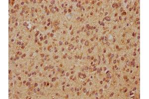 IHC image of ABIN7152257 diluted at 1:560 and staining in paraffin-embedded human glioma cancer performed on a Leica BondTM system. (EXOC7 anticorps  (AA 521-735))