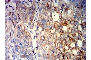Immunohistochemical analysis of paraffin-embedded liver cancer tissues using CCND1 mouse mAb with DAB staining.