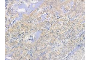 ABIN6264471 and ABIN6278269 at 1/100 staining human lung adenocarcinoma by IHC-P. (PSMA5 anticorps  (N-Term))