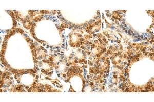 Immunohistochemistry of paraffin-embedded Human thyroid cancer using Otocadherin Polyclonal Antibody at dilution of 1:80 (CDH23 anticorps)