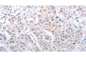 Immunohistochemistry of paraffin-embedded Human lung cancer using SLC39A6 Polyclonal Antibody at dilution of 1:30