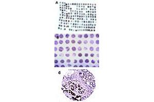 Formalin-fixed, paraffin-embedded tissue human colon microarray stained for CARD8 expression at 1 : 2000. (CARD8 anticorps)