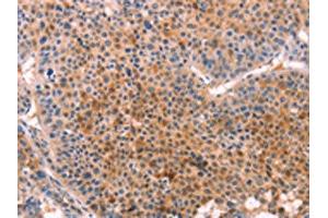 The image on the left is immunohistochemistry of paraffin-embedded Human liver cancer tissue using ABIN7129127(CYP1B1 Antibody) at dilution 1/20, on the right is treated with fusion protein.