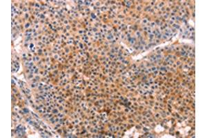 The image on the left is immunohistochemistry of paraffin-embedded Human liver cancer tissue using ABIN7129127(CYP1B1 Antibody) at dilution 1/20, on the right is treated with fusion protein. (CYP1B1 anticorps)