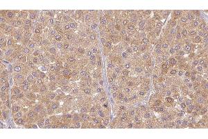 ABIN6277480 at 1/100 staining Human Melanoma tissue by IHC-P. (Neurotrophin 3 anticorps  (Internal Region))