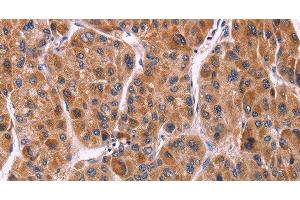 Immunohistochemistry of paraffin-embedded Human liver cancer tissue using Ephrin A5 Polyclonal Antibody at dilution 1:40 (Ephrin A5 anticorps)