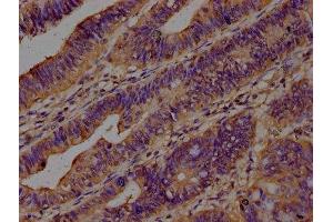 IHC image of ABIN7143354 diluted at 1:200 and staining in paraffin-embedded human colon cancer performed on a Leica BondTM system.