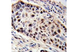 PCNA antibody immunohistochemistry analysis in formalin fixed and paraffin embedded human lung carcinoma. (PCNA anticorps  (AA 231-261))