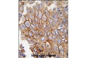 Formalin-fixed and paraffin-embedded human lung carcinoma tissue reacted with ANXA2 antibody , which was peroxidase-conjugated to the secondary antibody, followed by DAB staining.
