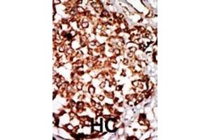 Formalin-fixed and paraffin-embedded human cancer tissue reacted with the primary antibody, which was peroxidase-conjugated to the secondary antibody, followed by DAB staining.