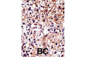Formalin-fixed and paraffin-embedded human cancer tissue reacted with CAPRIN1 polyclonal antibody  , which was peroxidase-conjugated to the secondary antibody, followed by DAB staining . (Caprin-1 anticorps  (AA 625-654))