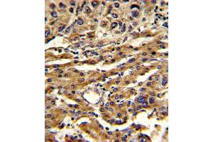 Formalin-fixed and paraffin-embedded human hepatocarcinoma reacted with ABCG1 Antibody , which was peroxidase-conjugated to the secondary antibody, followed by DAB staining. (ABCG1 anticorps  (AA 359-387))
