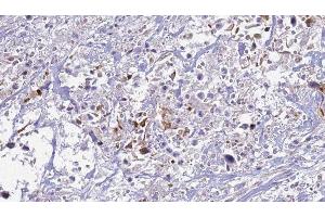 ABIN6277521 at 1/100 staining Human urothelial cancer tissue by IHC-P. (S100A12 anticorps)