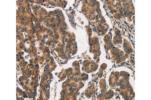 Immunohistochemistry of Human breast cancer using ITGA2 Polyclonal Antibody at dilution of 1:30