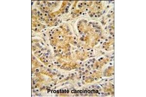 MOBKL1B Antibody (C-term) (ABIN391568 and ABIN2841505) IHC analysis in formalin fixed and paraffin embedded human Prostate carcinoma followed by peroxidase conjugation of the secondary antibody and DAB staining.