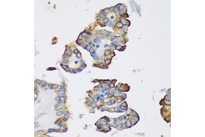 Immunohistochemistry of paraffin-embedded Human thyroid cancer using DYNLRB1 Rabbit pAb (ABIN7266866) at dilution of 1:100 (40x lens). (DYNLRB1 anticorps  (AA 1-63))