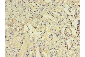 Immunohistochemistry of paraffin-embedded human lung tissue using ABIN7144554 at dilution of 1:100 (ACAP1 anticorps  (AA 1-266))