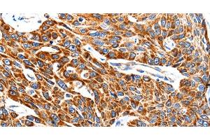 Immunohistochemistry of paraffin-embedded Human esophagus cancer using HSP75 Polyclonal Antibody at dilution of 1:100 (TRAP1 anticorps)