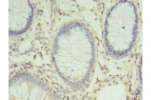 Immunohistochemistry of paraffin-embedded human colon cancer using ABIN7147533 at dilution of 1:100