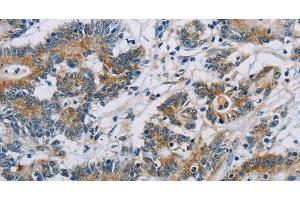 Immunohistochemistry of paraffin-embedded Human colon cancer using CSNK1E Polyclonal Antibody at dilution of 1:60 (CK1 epsilon anticorps)
