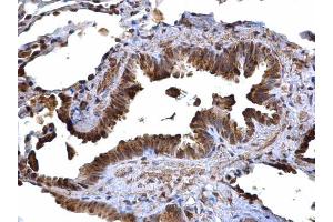 IHC-P Image CD74 antibody [N1N2], N-term detects CD74 protein at cytoplasm on human lung carcinoma by immunohistochemical analysis. (CD74 anticorps  (N-Term))