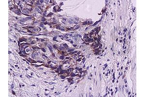 Formalin-fixed and paraffin embedded human esophageal carcinoma labeled with Anti-WIG-1/PAG608 Polyclonal Antibody, Unconjugated (ABIN730108) at 1:200, followed by conjugation to the secondary antibody and DAB staining