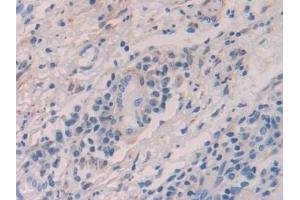 Detection of ADH1 in Human Skin cancer Tissue using Polyclonal Antibody to Alcohol Dehydrogenase 1 (ADH1)