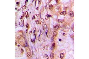 Immunohistochemical analysis of MAF1 staining in human breast cancer formalin fixed paraffin embedded tissue section. (MAF1 anticorps  (Center))