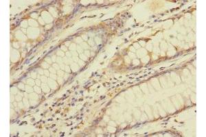 Immunohistochemistry of paraffin-embedded human colon cancer using ABIN7145902 at dilution of 1:100