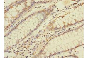 Immunohistochemistry of paraffin-embedded human colon cancer using ABIN7145902 at dilution of 1:100 (BTNL3 anticorps  (AA 18-237))