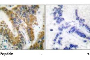 Immunohistochemical analysis of paraffin-embedded human lung carcinoma tissue, using CRKL polyclonal antibody .